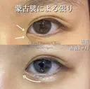 韓流目頭切開 after画像 サムネイル用