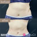脂肪吸引 before画像 サムネイル用