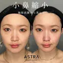 小鼻縮小 before画像 サムネイル用