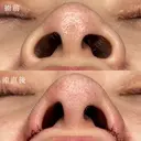 小鼻縮小 0日後 サムネイル用