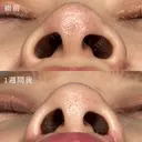 小鼻縮小 7日後 サムネイル用