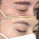 目尻ボトックス（アラガン） before画像 サムネイル用