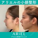 小顔整形（ほほ顎下脂肪吸引ジョールファット）＋額脂肪注入＋目の下のたるみとり 30日後 サムネイル用