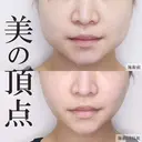 美ラインの複合小顔術😌糸リフト＆脂肪吸引 before画像 サムネイル用