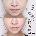 美ラインの複合小顔術😌糸リフト＆脂肪吸引 30日後 サムネイル用