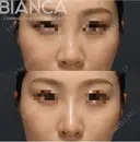 バランスのとれた美しい鼻に😘他院修正 before画像 サムネイル用