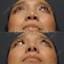鼻先を高く🦄 before画像 サムネイル用