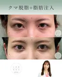 クマ脱脂＋脂肪注入 after画像 サムネイル用
