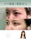 クマ脱脂＋脂肪注入 after画像 サムネイル用