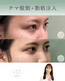 クマ脱脂＋脂肪注入 after画像 サムネイル用