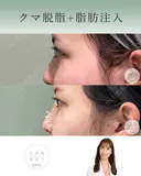 クマ脱脂＋脂肪注入 after画像 サムネイル用