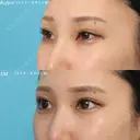 目尻切開術＋グラマラスライン before画像 サムネイル用