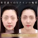 希望通りのVライン輪郭🦊 30日後 サムネイル用