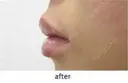 口唇ヒアルロン酸注入 after画像 サムネイル用