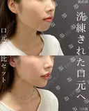 【✨口元黄金比セット保存版】7日後 before画像 サムネイル用