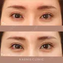 下眼瞼拡大（グラマラスライン）、目尻切開、下眼瞼脱脂 before画像 サムネイル用
