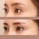 下眼瞼拡大（グラマラスライン）、目尻切開、下眼瞼脱脂 after画像 サムネイル用