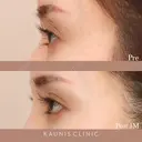 下眼瞼拡大（グラマラスライン）、目尻切開、下眼瞼脱脂 after画像 サムネイル用