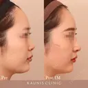 鼻中隔延長、鼻尖形成、隆鼻術（オーダーメードプロテーゼ） after画像 サムネイル用