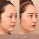 鼻中隔延長、鼻尖形成、隆鼻術（オーダーメードプロテーゼ） after画像 サムネイル用