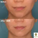 糸リフト　VOVリフト before画像 サムネイル用