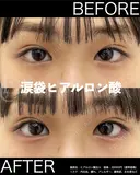 涙袋ヒアルロン酸 before画像 サムネイル用