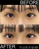 涙袋ヒアルロン酸 after画像 サムネイル用