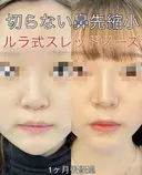 切らない鼻先縮小術＋ルラ式スレッドノーズ before画像 サムネイル用