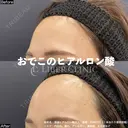 おでこのヒアルロン酸 before画像 サムネイル用