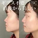 【鼻整形の複合手術】 before画像 サムネイル用