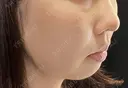 脂肪吸引×ドリームスレッド×テスリフト×ボトックス（エラ） before画像 サムネイル用