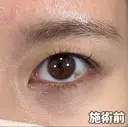☆BELINDA二重術 before画像 サムネイル用