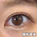 ☆BELINDA二重術 0日後 サムネイル用