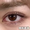 ☆BELINDA二重術 0日後 サムネイル用