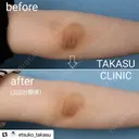 意外と気付かない🤔関節部分の黒ずみを除去✨✨ before画像 サムネイル用