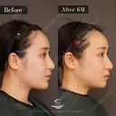 輪郭3点（エラ＋頬骨＋オトガイ） before画像 サムネイル用