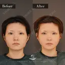 輪郭3点（エラ＋頬骨＋オトガイ） before画像 サムネイル用