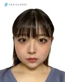 脂肪吸引(頬•顎下)/バッカルファット除去/顎ヒアルロン酸/エラボトックス/二重埋没法 30日後 サムネイル用