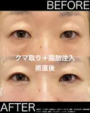 術直後からこの仕上がり！クマ取り＋脂肪注入 before画像 サムネイル用