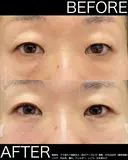 術直後からこの仕上がり！クマ取り＋脂肪注入 after画像 サムネイル用