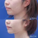 顎元のもたつきを顔の脂肪吸引で解消😄 before画像 サムネイル用