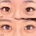埋没法二重術（クイックシンデレラ・トリプル）＋MD式目頭切開 90日後 サムネイル用