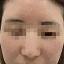 ポテンツァ　ドラッグデリバリー（マックーム使用） before画像 サムネイル用