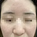 ポテンツァ　ドラッグデリバリー（マックーム使用） 30日後 サムネイル用