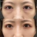 切らない目の下のたるみ取り＋脂肪注入 after画像 サムネイル用