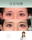 目尻切開 before画像 サムネイル用