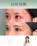 目尻切開 after画像 サムネイル用