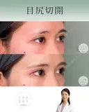 目尻切開 after画像 サムネイル用