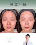 鼻翼縮小 before画像 サムネイル用