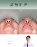 鼻翼縮小 after画像 サムネイル用